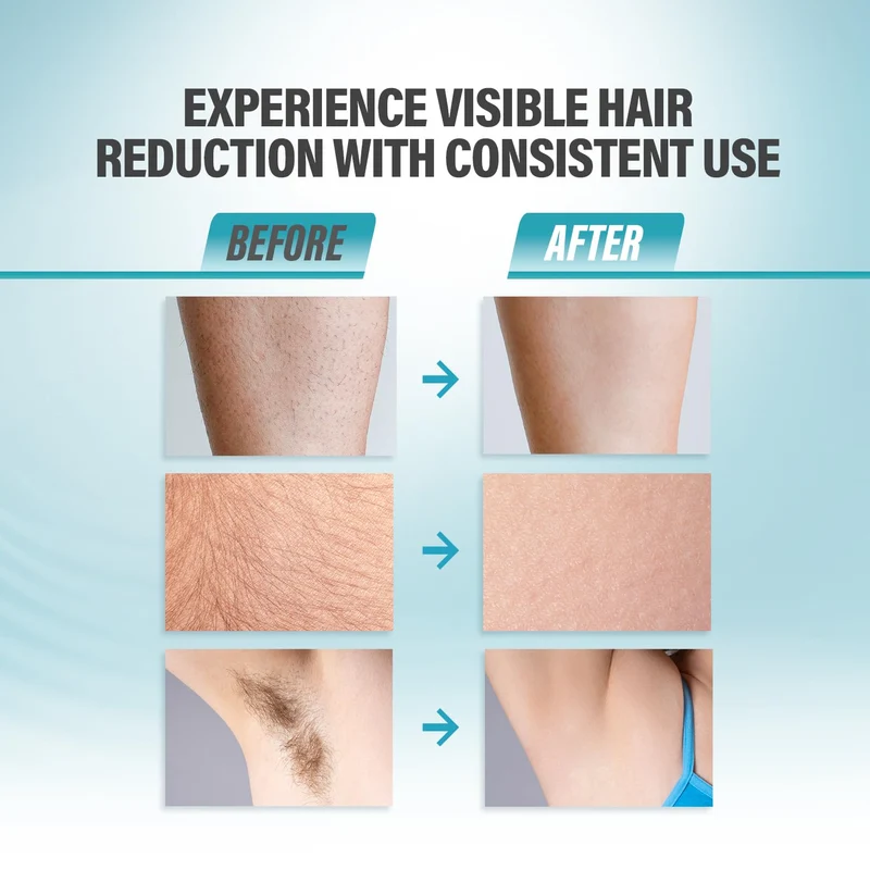 Herbishh IPL-Laser-Haarentfernungsgerät