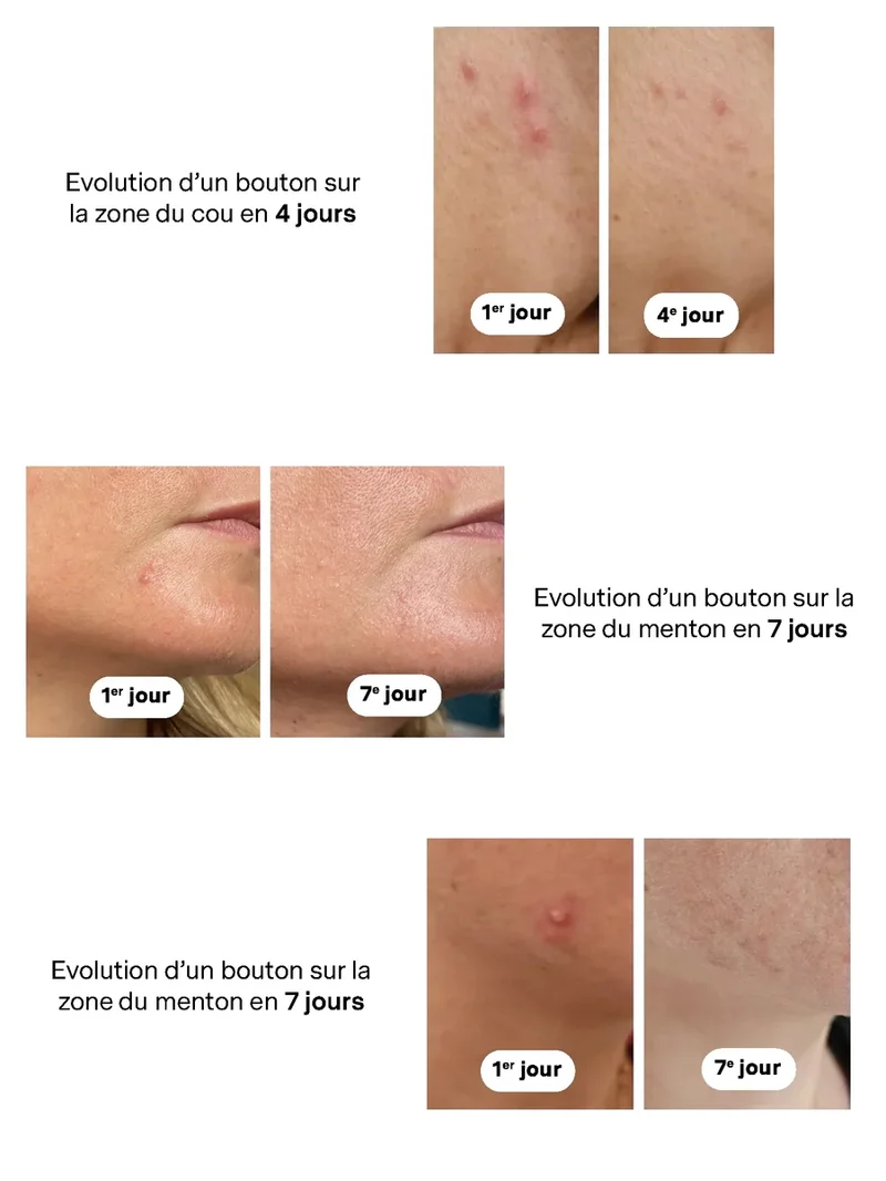 Blemish Treatment 12 ml