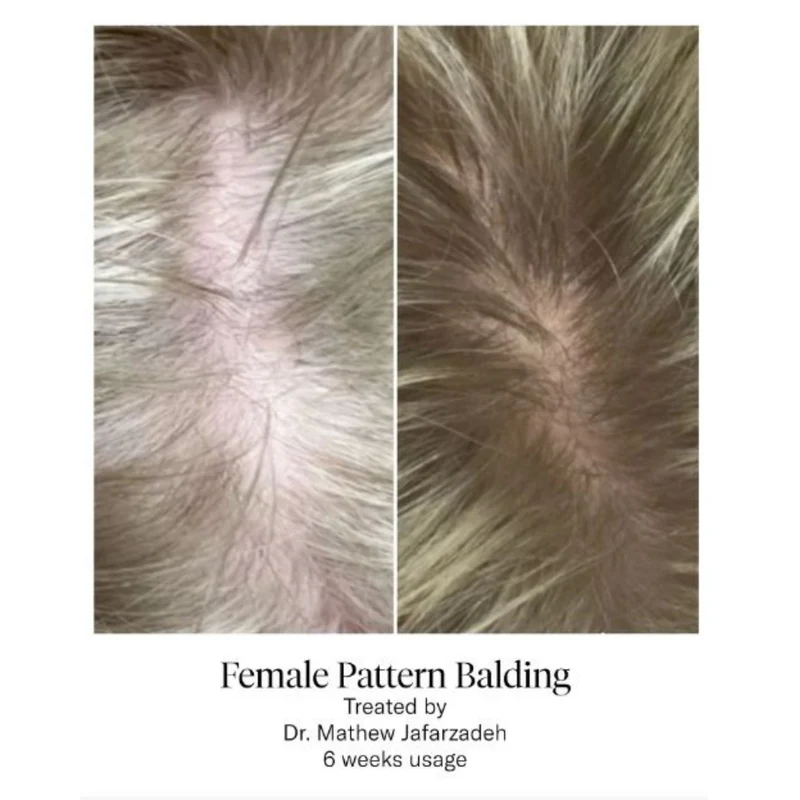Calecim Advanced Hair System Kit