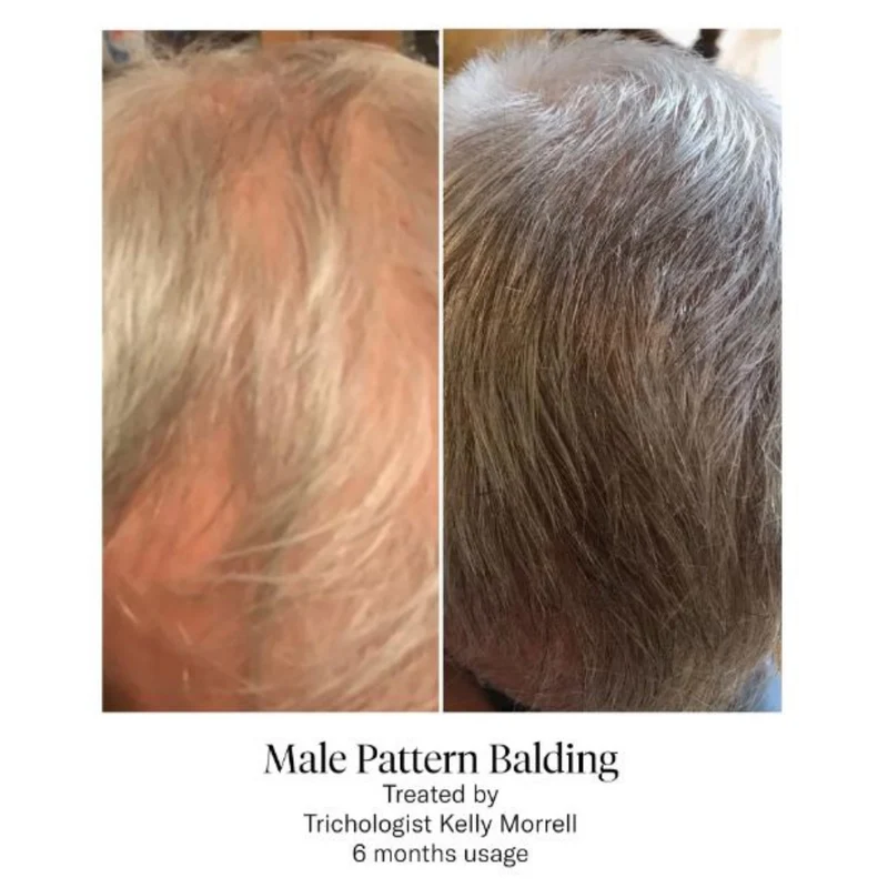 Calecim Advanced Hair System Kit