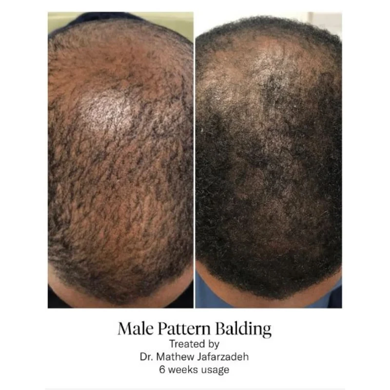 Calecim Advanced Hair System Kit